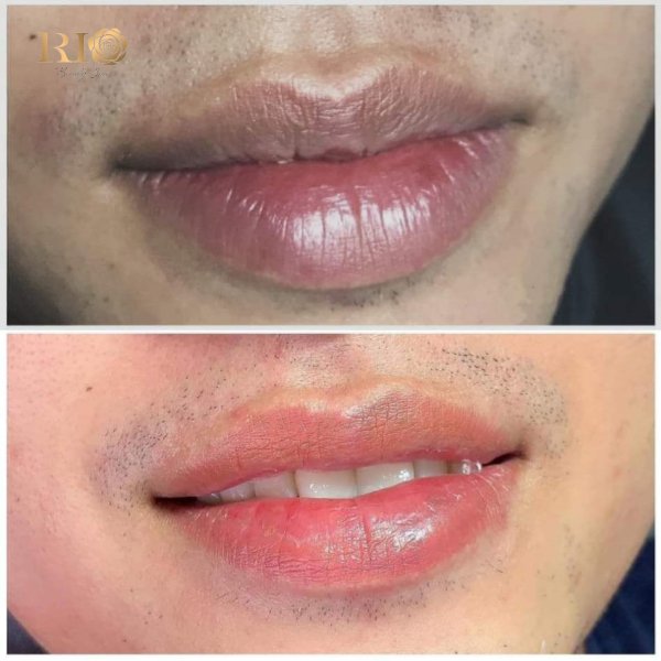 About Us 10 Xử lý môi thâm cũ hỏng bằng phương pháp khử thâm công nghệ Laser kết hợp phun xăm màu da môi tự nhiên