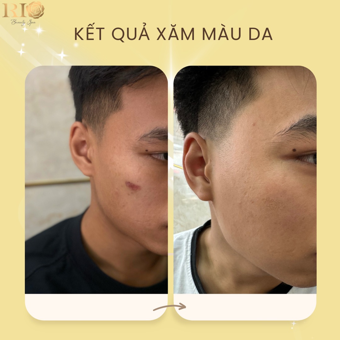 Xăm Màu Da Che Tàn Nhang: Cứu cánh cho các chị em phụ nữ 3 Xăm màu da che tàn nhang