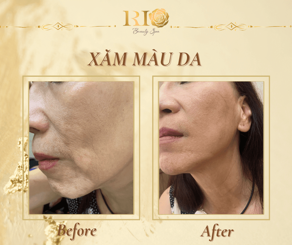 Eyebrow Sculpting 53 Quy trình xăm màu da che bạch biến được tiến hành cẩn thận, đảm bảo vô trùng tuyệt đối, giảm thiểu tối đa nguy cơ kích ứng hay tổn thương da. Sau liệu trình, khách hàng sẽ cảm nhận rõ sự cải thiện về màu sắc da, tăng sự tự tin và thoải mái trong giao tiếp hàng ngày.