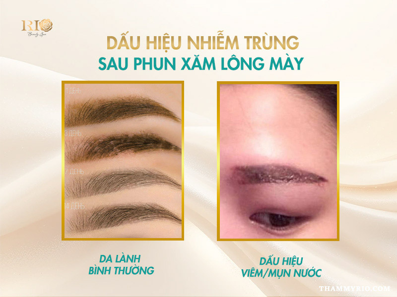 Chân mày điêu khắc sau 1 tuần như thế nào? Cách chăm sóc đúng 5 Dấu hiệu bất thường cần lưu ý khi chân mày điêu khắc sau 1 tuần.