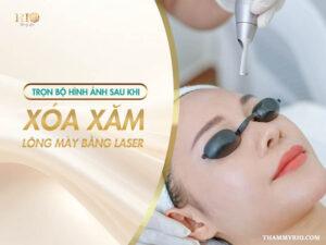 Cùng Thẩm Mỹ Rio khám phá bộ hình ảnh sau khi xóa xăm lông mày bằng Laser được thực hiện tại Thẩm Mỹ Rio Beauty Clinic