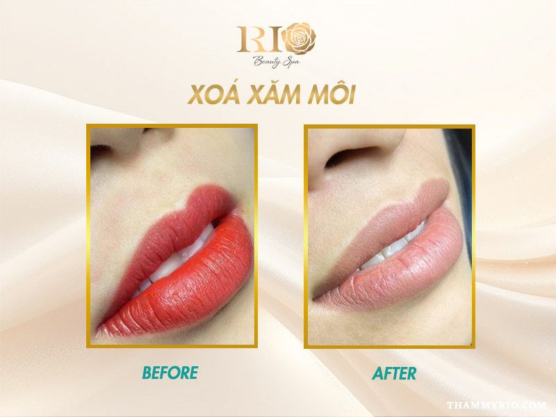 Xăm môi xong có xóa được không? 5 giải pháp hiệu quả nhất 8 Xăm môi xong có xóa được không khi môi đỏ đậm?