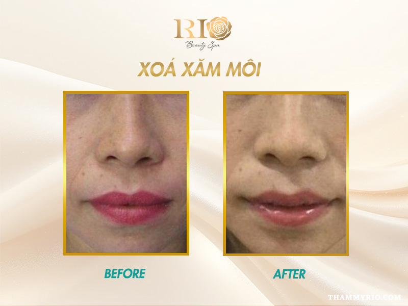 Xăm môi xong có xóa được không? 5 giải pháp hiệu quả nhất 10 Xăm môi xong có xóa được không khi màu quá đậm?