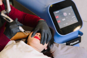 cách xóa viền môi phun tại Thẩm Mỹ Rio Beauty Clinic áp dụng những công nghệ laser tiên tiến nhất