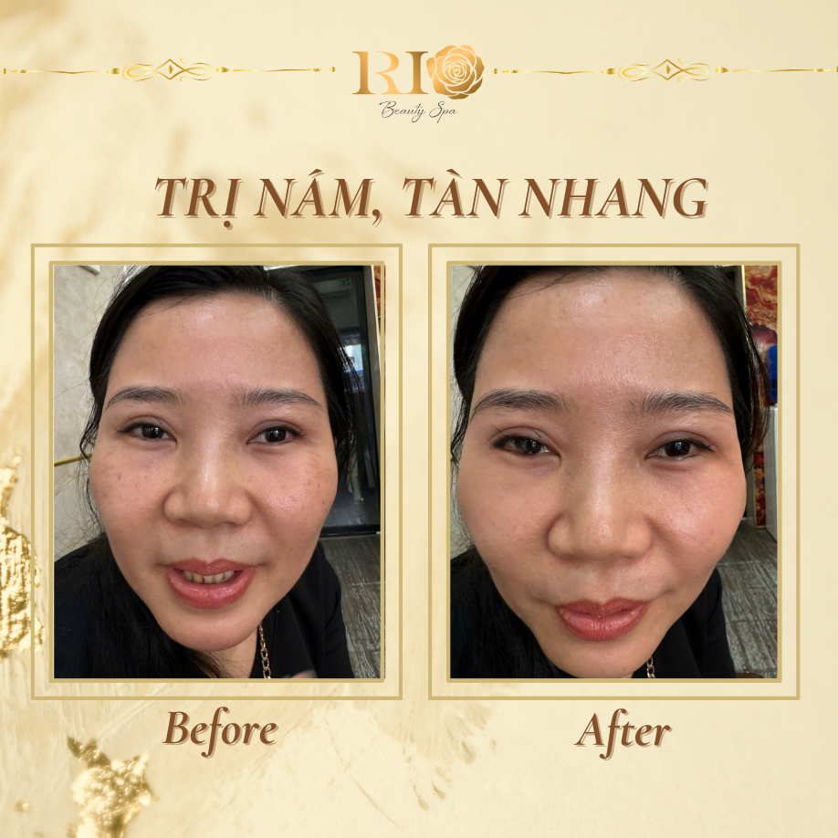 Home 26 dich-vu-tri-nam-tan-nhang-thammyrio.com