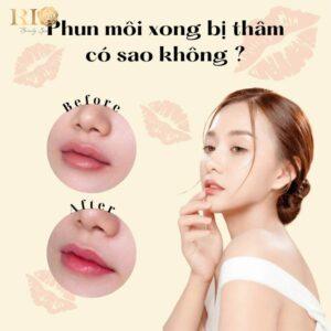 Phun môi xong bị thâm có sao không? Tìm hiểu nguyên nhân