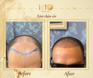 Xăm chân tóc - Giải pháp hiệu quả cho đầu tóc thưa, hói