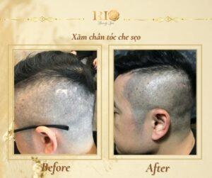 Xăm chân tóc che sẹo - Giải pháp thẩm mỹ hoàn hảo