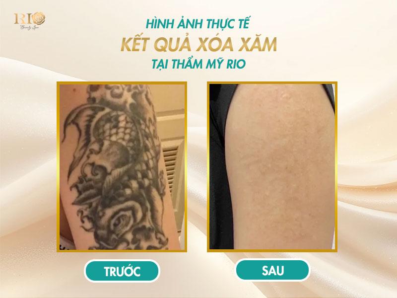 Xóa xăm mấy lần mới hết? Giải đáp đầy đủ và dễ hiểu 10 Xóa xăm hình cá chép trên cánh tay hiệu quả tại Thẩm Mỹ Rio