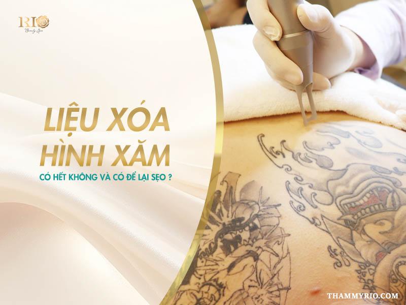Xóa xăm mấy lần mới hết? Giải đáp đầy đủ và dễ hiểu 5 Xóa hình xăm có hết không cũng là một câu hỏi mang nỗi lo của khách hàng. Bên cạnh đó, nhiều người lo sợ phải xóa xăm nhiều lần sẽ khiến da bị tổn thương.