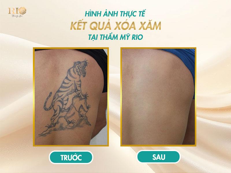 Xóa xăm mấy lần mới hết? Giải đáp đầy đủ và dễ hiểu 7 Kết quả xóa xăm hình xăm con hổ, trước và sau tại Thẩm Mỹ Rio
