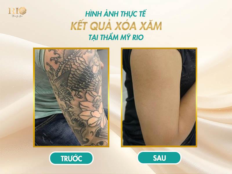 Xóa xăm mấy lần mới hết? Giải đáp đầy đủ và dễ hiểu 8 Kết quả xóa xăm thành công một hình xăm phức tạp tại Thẩm Mỹ Rio Beauty Clinic