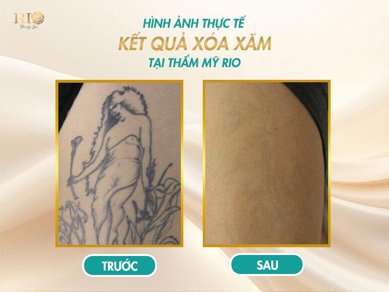 Xóa xăm mấy lần mới hết? Giải đáp đầy đủ và dễ hiểu 9 Kết quả trước và sau khi xóa xăm thành công tại Thẩm Mỹ Rio Beauty Clinic