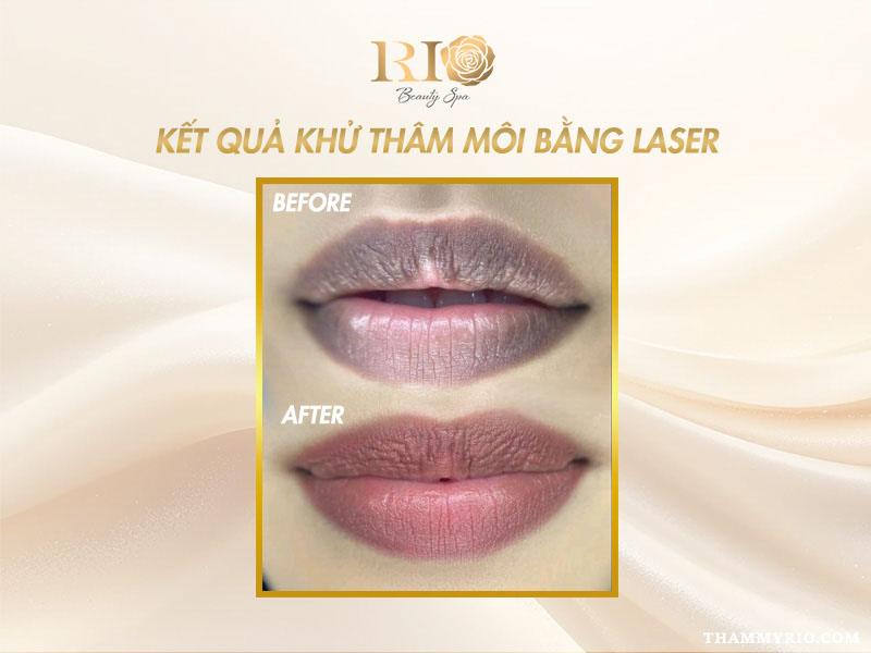 Khử thâm môi bằng Laser: Tất tần tật thông tin bạn cần biết 10 Hình ảnh trước và sau khi khử thâm môi bằng Laser