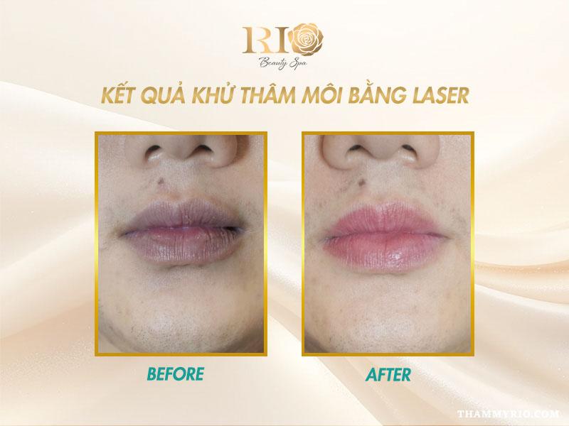 Khử thâm môi bằng Laser: Tất tần tật thông tin bạn cần biết 8 Kết quả khử thâm môi bằng Laser cho một khách hàng nam tại Thẩm Mỹ Rio Beauty Clinic