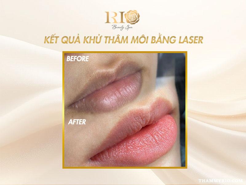 Khử thâm môi bằng Laser: Tất tần tật thông tin bạn cần biết 9 Kết quả khử thâm môi bằng Laser cho một bạn khách hàng nữ tại Thẩm Mỹ Rio Beauty Clinic