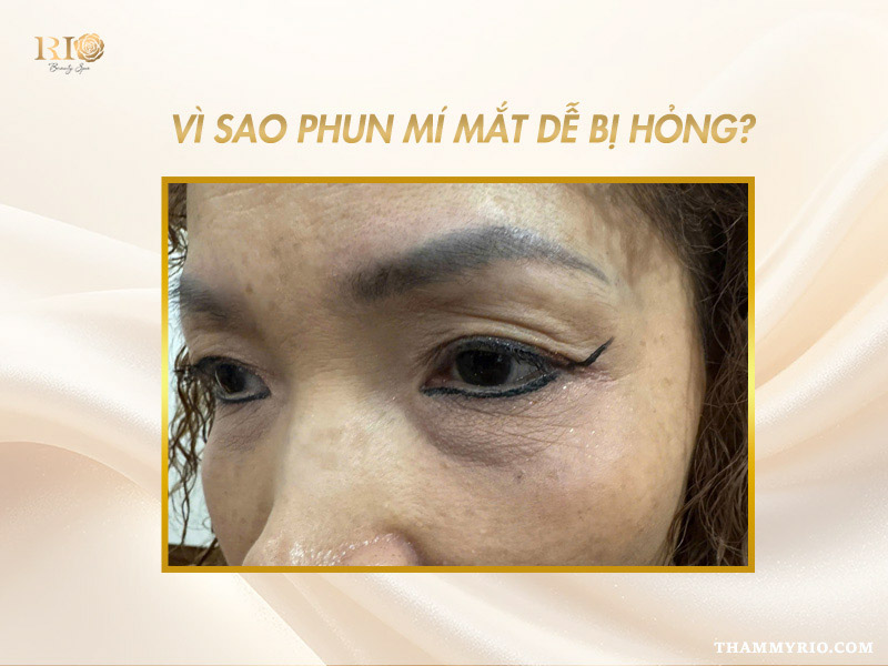 Xăm mí mắt bị hỏng phải làm sao? Giải pháp nào khắc phục 3 Nguyên nhân khiến xăm mí mắt bị hỏng do tay nghề kém hoặc dùng mực xăm kém chất lượng.