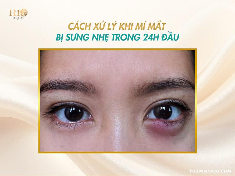 Xăm mí mắt dưới là gì? Bảng giá & hình ảnh mới nhất 2026 14 Cách xử lý khi mí mắt bị sưng nhẹ sau xăm mí dưới