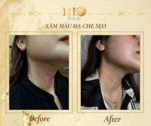 Xăm màu da che sẹo - Bí quyết để có làn da hoàn hảo