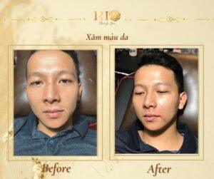 Xăm màu da che sẹo - Bí quyết để có làn da hoàn hảo