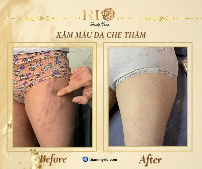 Hình ảnh thực tế trước và sau khi thực hiện xăm màu da che vết rạn da