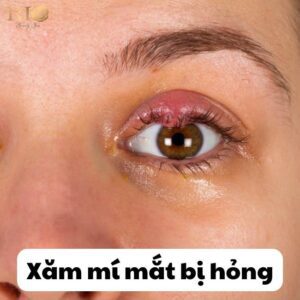 xam mi mat bi hong 2