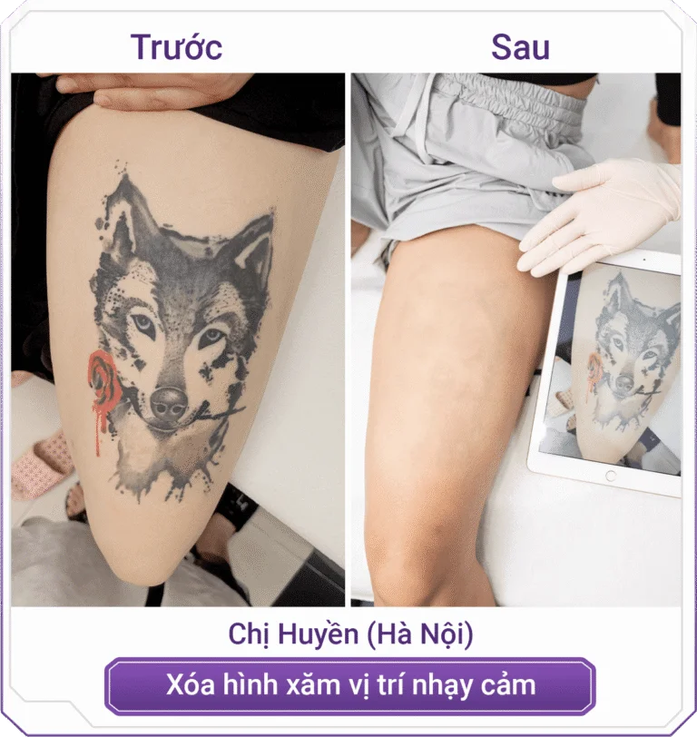 Tattoo Removal 43 C Huyen 1 768x812 1