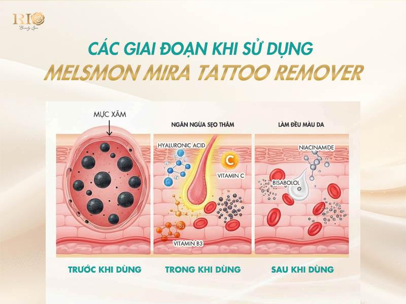 Melsmon Mira Tattoo Remover : Phục hồi da sau xóa xăm laser hoàn hảo 7 Sự khác biệt của Melsmon Mira Tattoo Remover nằm ở công thức độc quyền, kết hợp các thành phần dưỡng da cao cấp được nghiên cứu kỹ lưỡng, mang lại hiệu quả tối ưu và toàn diện cho làn da sau liệu trình xóa xăm.