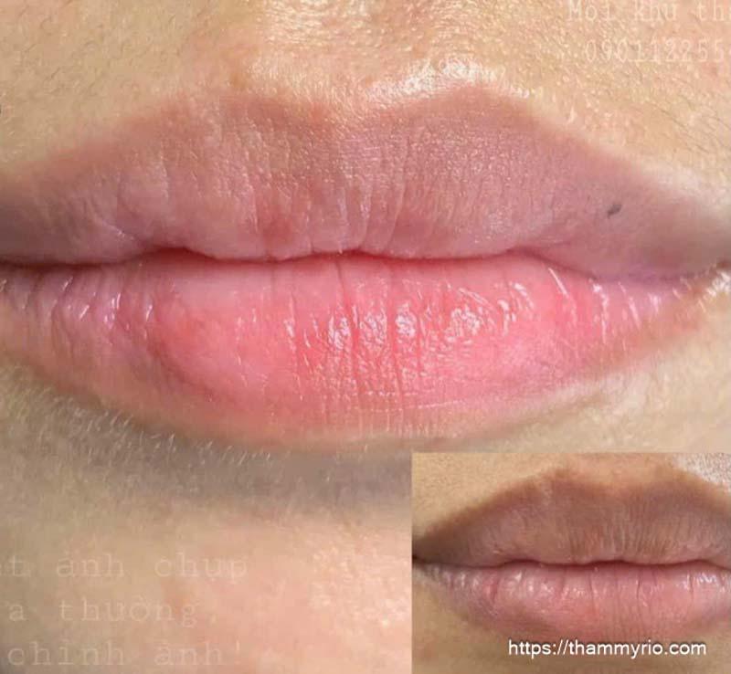 Cách trị thâm viền môi hiệu quả phương pháp mới nhất 2025  16 Với những tình trạng thâm nặng, lâu năm, sử dụng công nghệ khử thâm môi bằng công nghệ Spectra ND Yag tại Thẩm Mỹ Rio Beauty Clinic sẽ là lựa chọn tối ưu, giúp bạn nhanh chóng sở hữu đôi môi sáng khỏe, đầy sức sống.