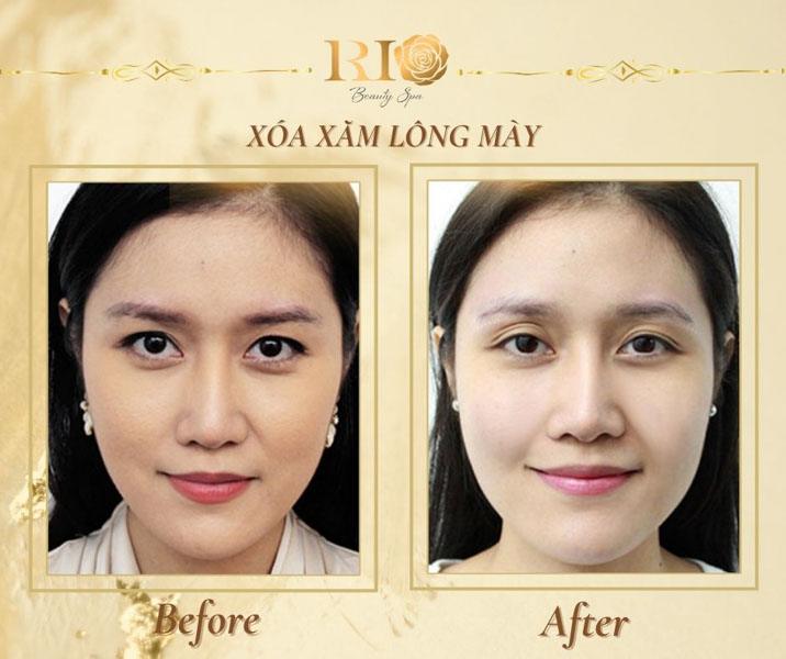 6 cách xóa xăm chân mày tại nhà đơn giản có thể bạn chưa biết 13 Cách xóa xăm chân mày tại nhà hiệu quả hơn nhờ công nghệ Hàn – Mỹ tại Rio