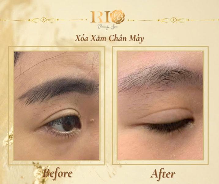 6 cách xóa xăm chân mày tại nhà đơn giản có thể bạn chưa biết 14 Cách xóa xăm chân mày tại nhà không đau rát với công nghệ laser tại Thẩm Mỹ Rio