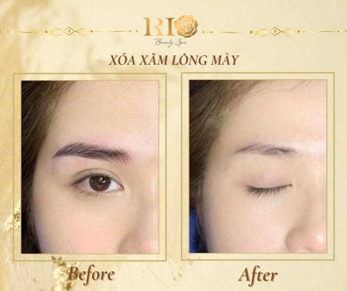 6 cách xóa xăm chân mày tại nhà đơn giản có thể bạn chưa biết 15 Cách xóa xăm chân mày tại nhà an toàn bằng công nghệ tại Rio