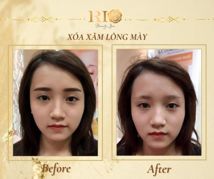 6 cách xóa xăm chân mày tại nhà đơn giản có thể bạn chưa biết 16 ách xóa xăm chân mày tại nhà với hiệu quả vượt trội tại Thẩm Mỹ Rio