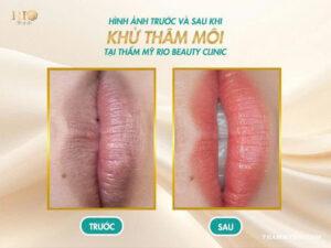 Kết quả khử thâm môi giúp môi hồng tự nhiên tại Thẩm Mỹ Rio Beauty Clinic