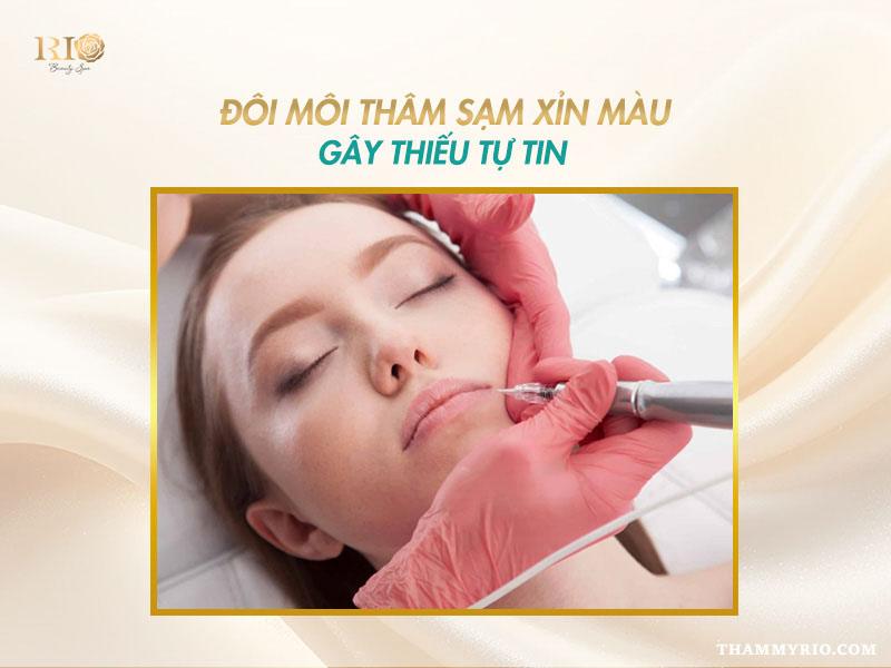 Khử thâm môi: Bí quyết cho đôi môi hồng hào tự nhiên 2 Môi thâm sạm xỉn màu trước khi khử thâm môi