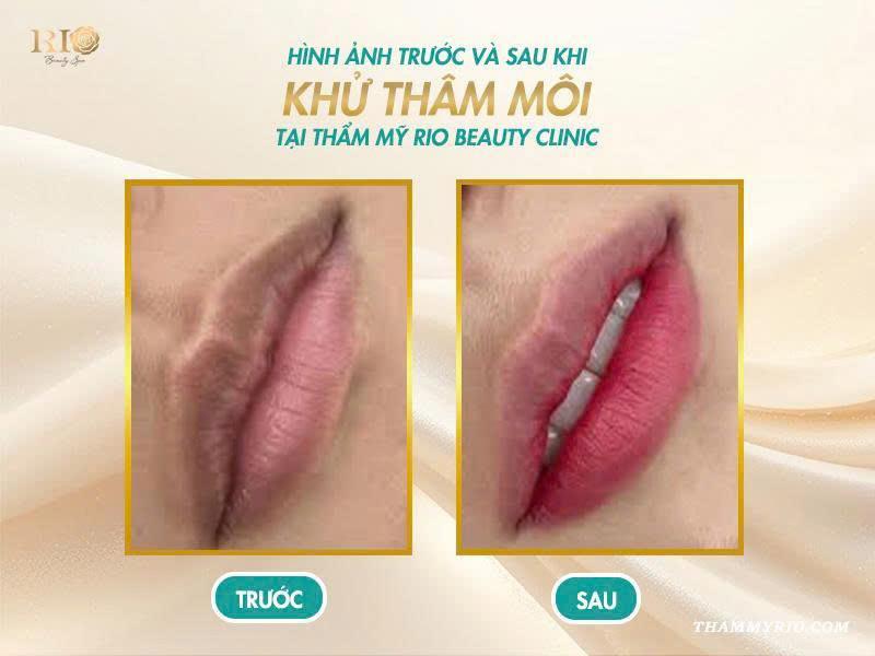 Khử thâm môi: Bí quyết cho đôi môi hồng hào tự nhiên 9 Kết quả khử thâm môi an toàn, không sưng đau, lên màu chuẩn hồng ruby