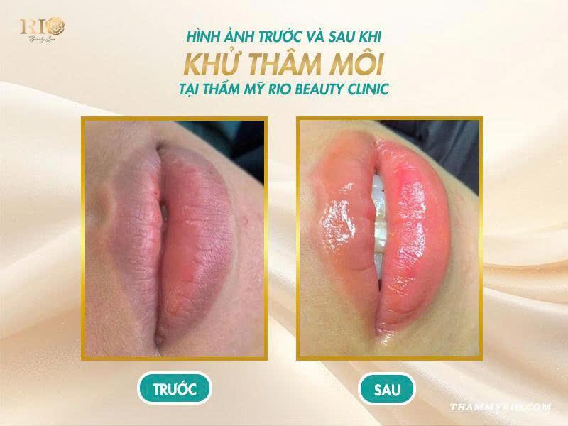 Khử thâm môi: Bí quyết cho đôi môi hồng hào tự nhiên 11 Môi sau khử thâm đều màu, căng bóng và tươi tắn tự nhiên