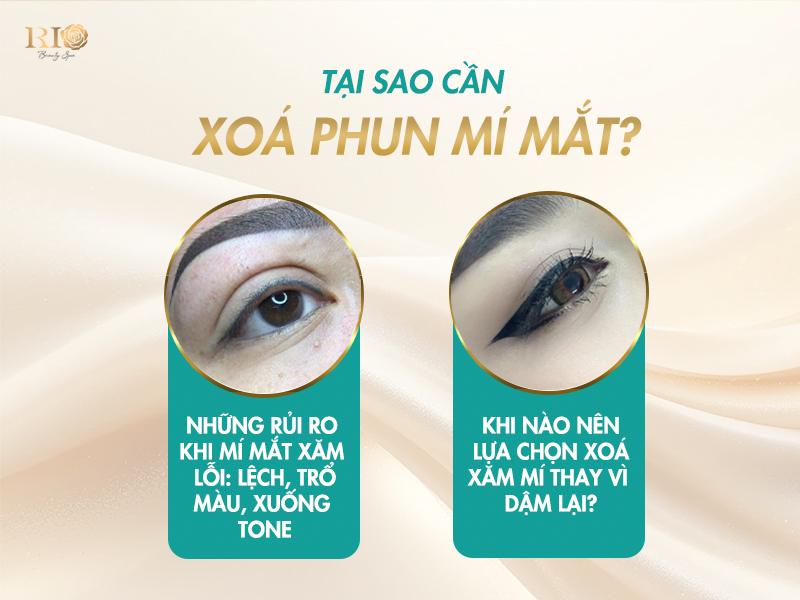Xóa xăm mí mắt 2025: Công nghệ xóa xăm nào an toàn nhất? 2 giải pháp xóa xăm mí mắt an toàn, hiệu quả trở nên cấp thiết. Trong vô vàn lựa chọn, công nghệ laser nổi lên như một "cứu cánh", đặc biệt là tại Thẩm Mỹ Rio Beauty Clinic – nơi tiên phong ứng dụng những công nghệ laser hiện đại nhất