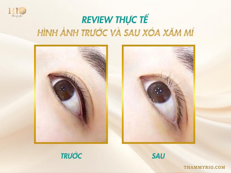 Xóa xăm mí mắt 2025: Công nghệ xóa xăm nào an toàn nhất? 10 Với công nghệ laser hiện đại và đội ngũ chuyên gia hàng đầu, Thẩm Mỹ Rio Beauty Clinic chính là lựa chọn lý tưởng để bạn loại bỏ những đường xăm mí lỗi, lấy lại đôi mắt đẹp tự nhiên và tự tin hơn