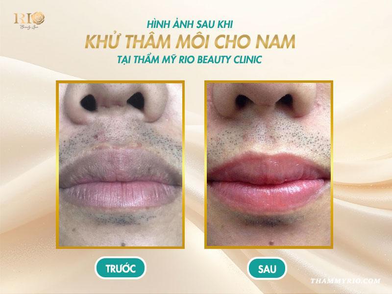Khử thâm môi: Bí quyết cho đôi môi hồng hào tự nhiên 12 Kết quả khử thâm môi nam