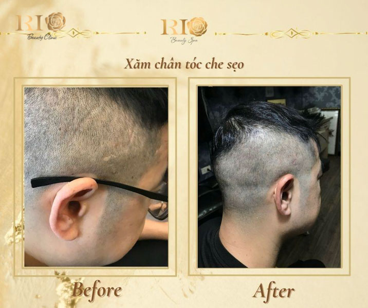 Xăm chân tóc che sẹo giúp che phủ sẹo trên da đầu bằng hiệu ứng sợi tóc tự nhiên tại Thẩm Mỹ Rio