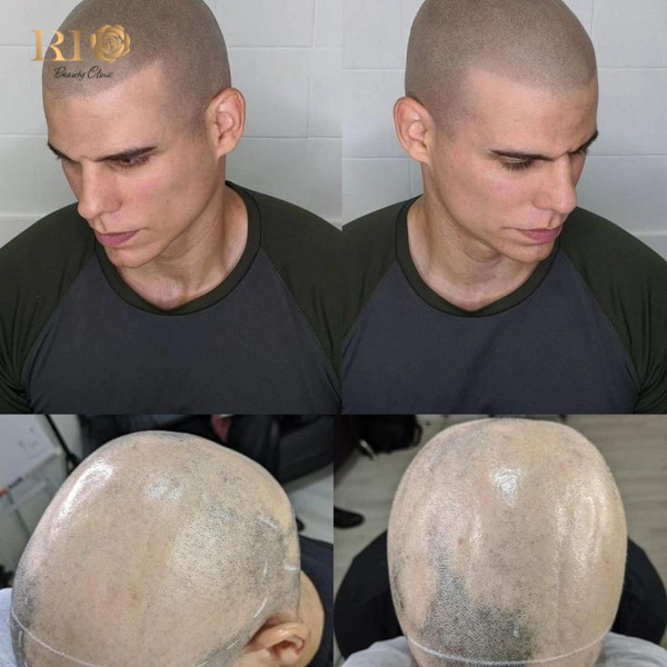 ket-qua-truoc-sau-xam-chan-toc-che-seo-va-tri-hoi-dau-tai-rio