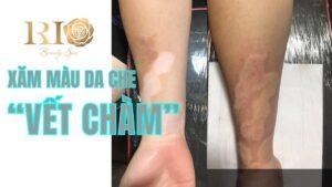 xam mau da che vet cham bam sinh 1