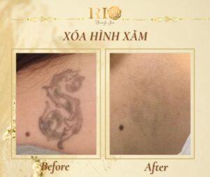 Chức năng xóa xăm và khử thâm của máy laser Nd Yag Spectra đạt chuẩn quốc tế