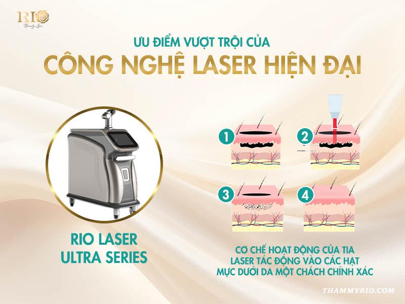 Xóa xăm nhũ hoa an toàn – Quy trình và bảng giá 2025 3 Công nghê Laser Ultra Series - Giải pháp tân tiến khi xóa xăm nhũ hoa.