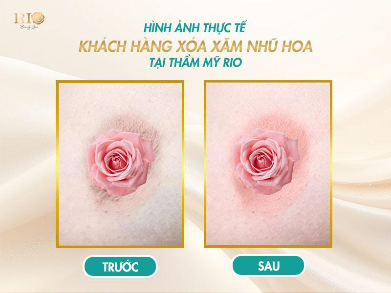 Xóa xăm nhũ hoa an toàn – Quy trình và bảng giá 2025 6 Hình ảnh trước và sau khi thực hiện xóa xăm nhũ hoa tại Thẩm Mỹ Rio Beauty Clinic.