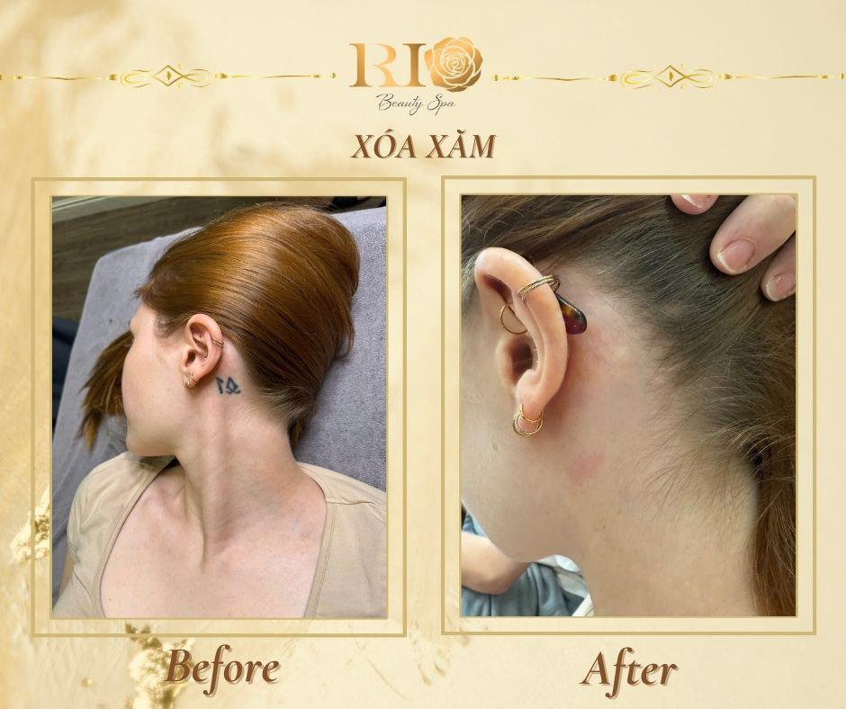 Xóa xăm uy tín: Những tiêu chí xóa xăm mới nhất 2025 8 Xóa hình xăm ở tai cho Em gái nước ngoài tại địa chỉ xoá hình xăm uy tín Thẩm Mỹ Rio beauty Clinic