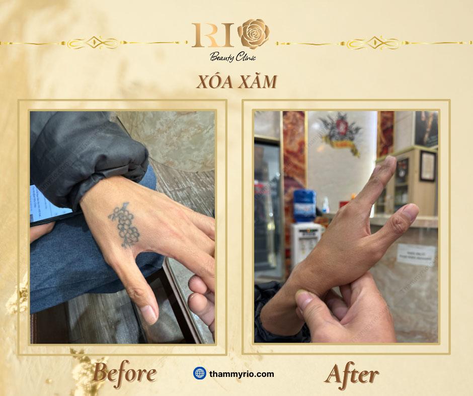 Xóa xăm uy tín: Những tiêu chí xóa xăm mới nhất 2025 3 xoa xam uy tin tham my rio beauty clinic 12 of 18