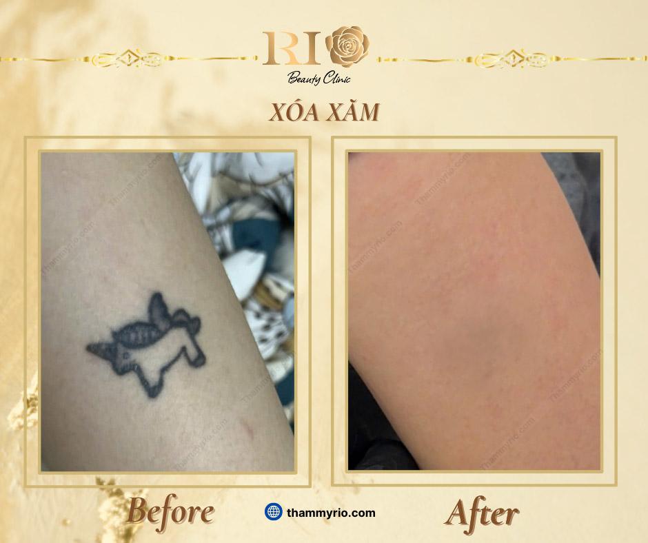 Xóa xăm uy tín: Những tiêu chí xóa xăm mới nhất 2025 9 Xóa hình xăm mini ở tay cho bạn nữ tại Thẩm Mỹ Rio