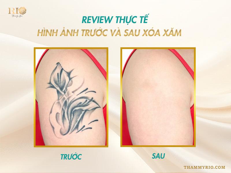 Xóa xăm uy tín: Những tiêu chí xóa xăm mới nhất 2025 10 Thẩm Mỹ Rio Beauty Clinic xóa hình xăm uy tín số 1 hiện nay tại Việt Nam